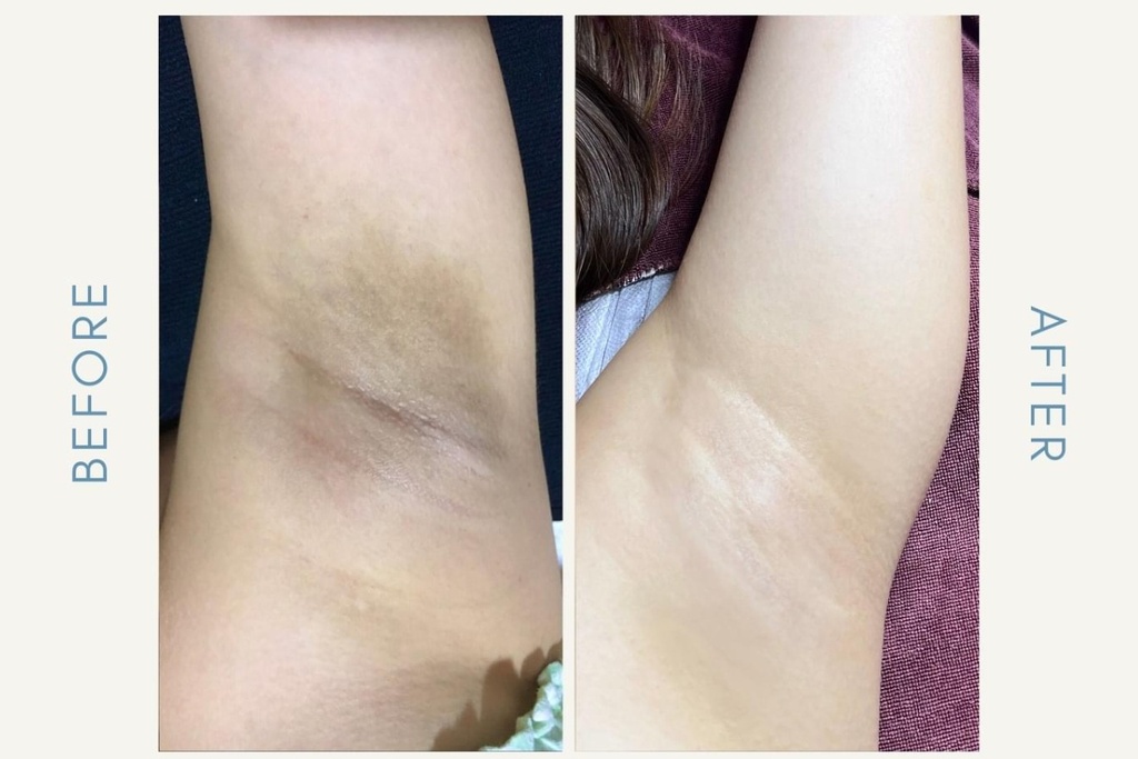 Underarm Whitening Treatment