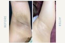 Underarm Whitening Treatment